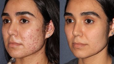 acne and acne scars sylhet