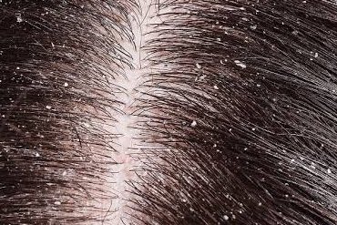 dandruff
