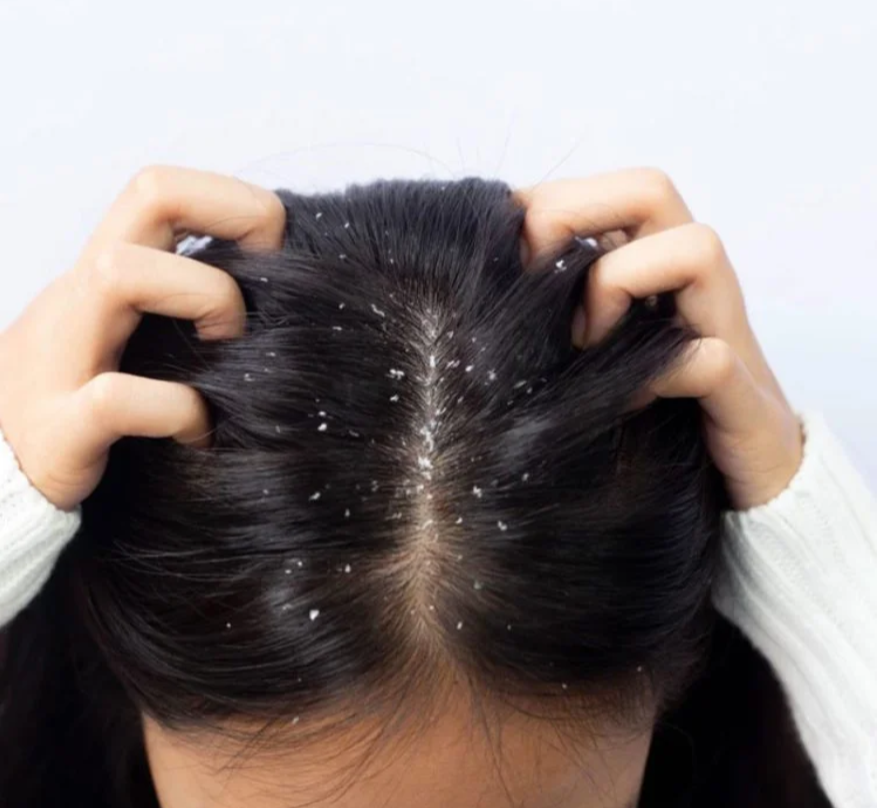 dandruff & scalp treatment