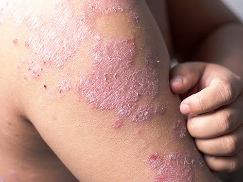 eczema & dermatitis