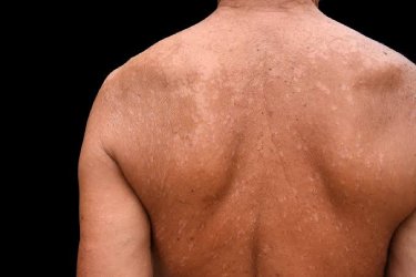 fungal skin infections