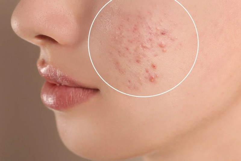 guide to preventing acne