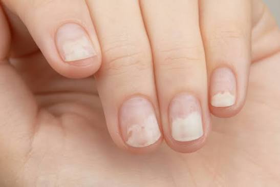 nail problems