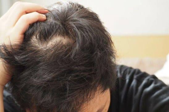hairfall