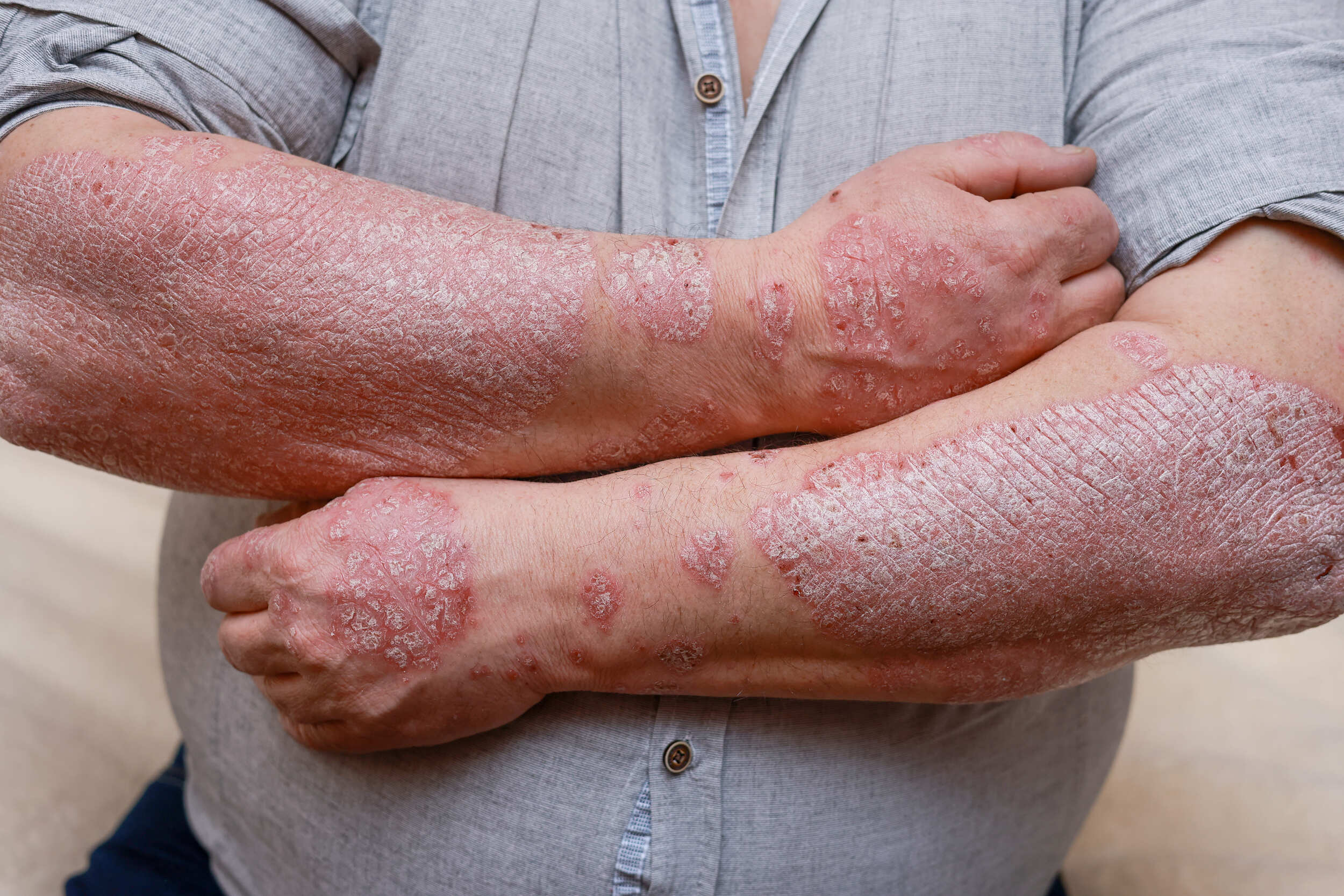 psoriasis sylhet