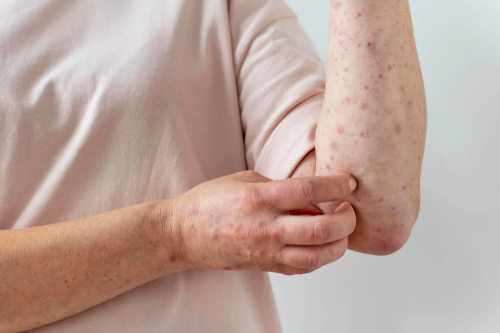 skin allergy sylhet